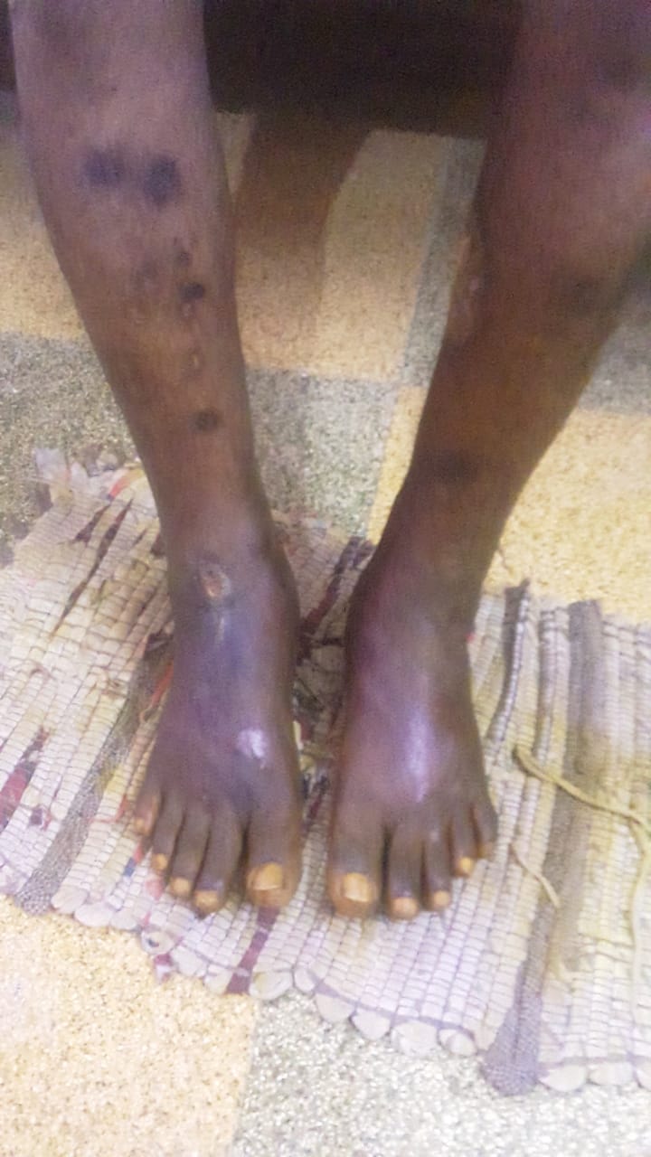 Idiopathic Case