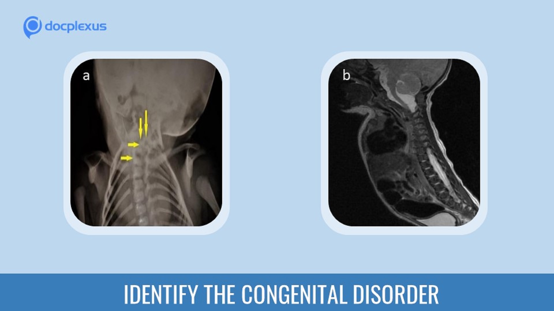 Identify the Underlying Congenital Disorder in This Infant