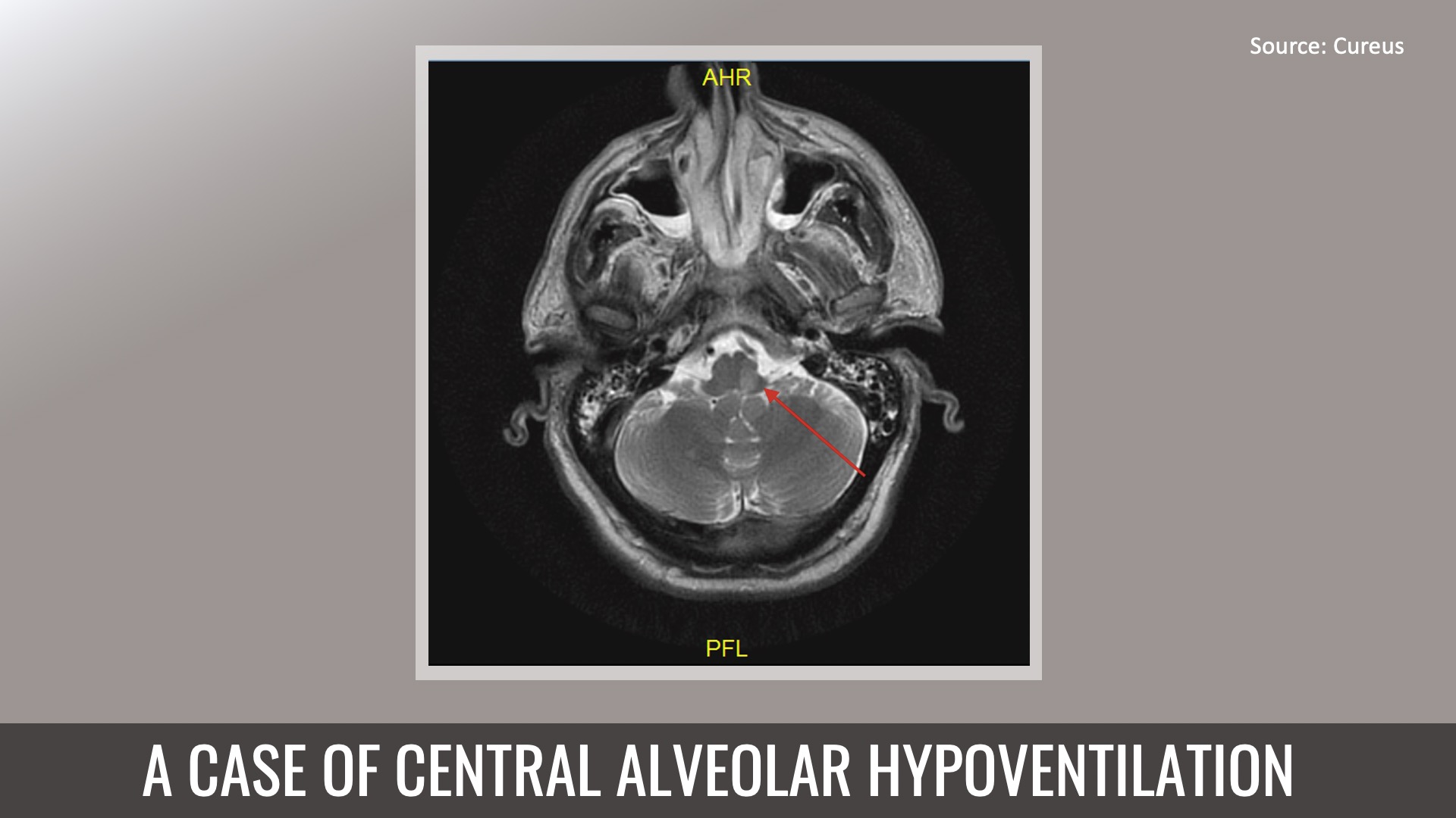 Identify the Cause of Central Alveolar Hypoventilation