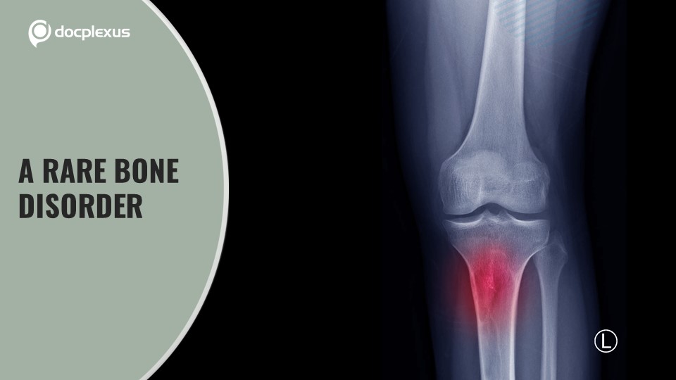 Answer This Question on a Rare Bone Disorder