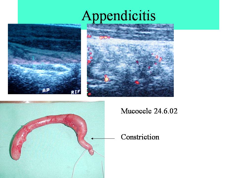 Appendicitis in An Ultrasound Image