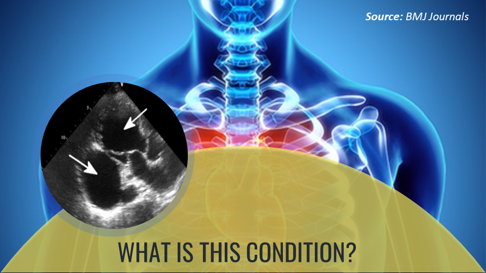 Pan-systolic Murmurs with No Chest pain – What’s Your Diagnosis?