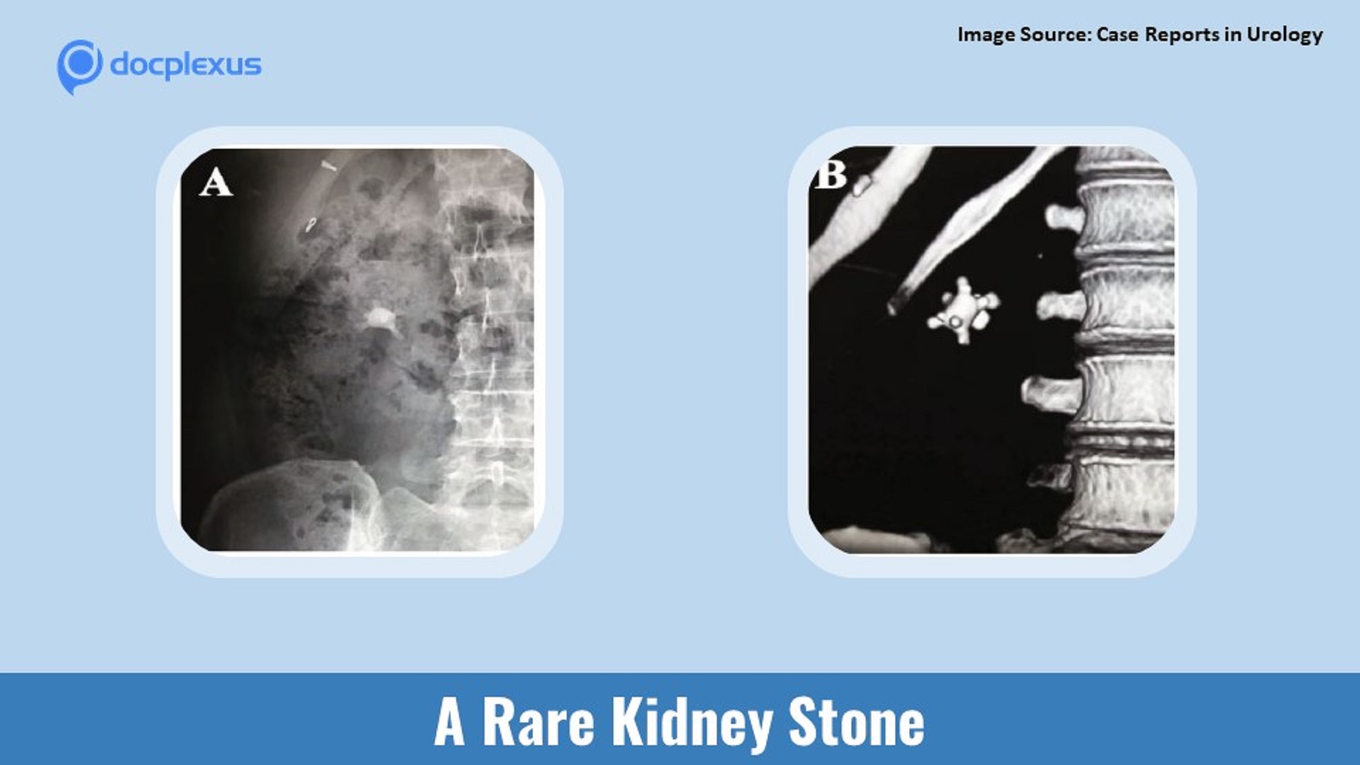 A Rare Kidney Stone