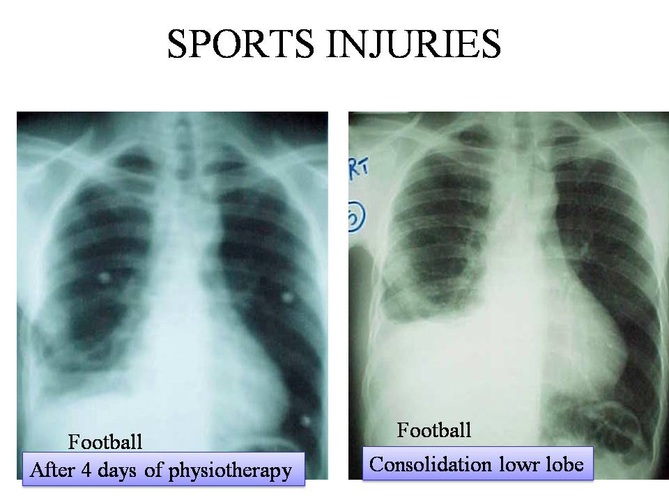 Sport Injury of Lung
