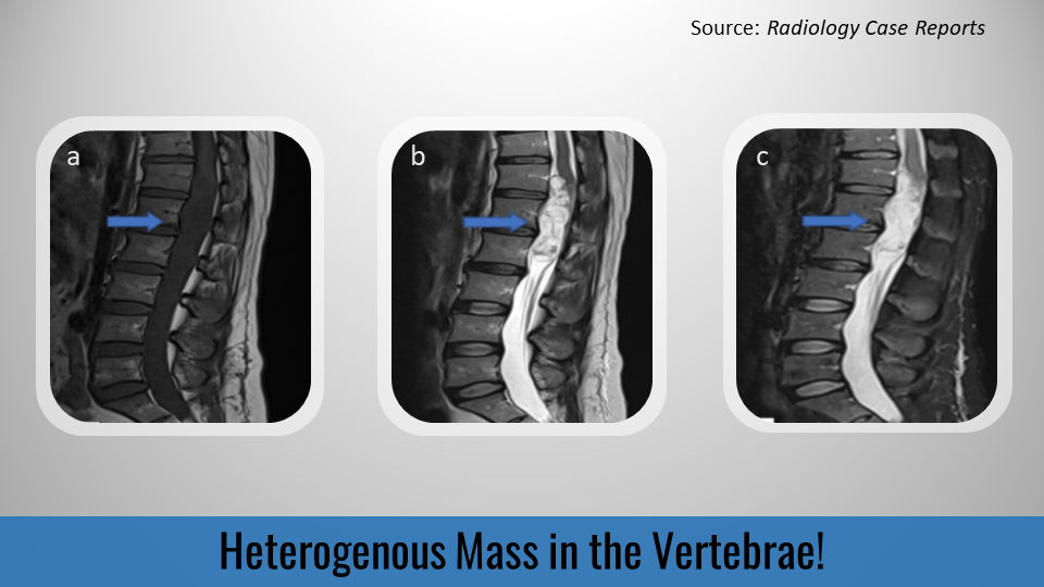 Case of a Woman with a Heterogeneous Mass in the Vertebrae