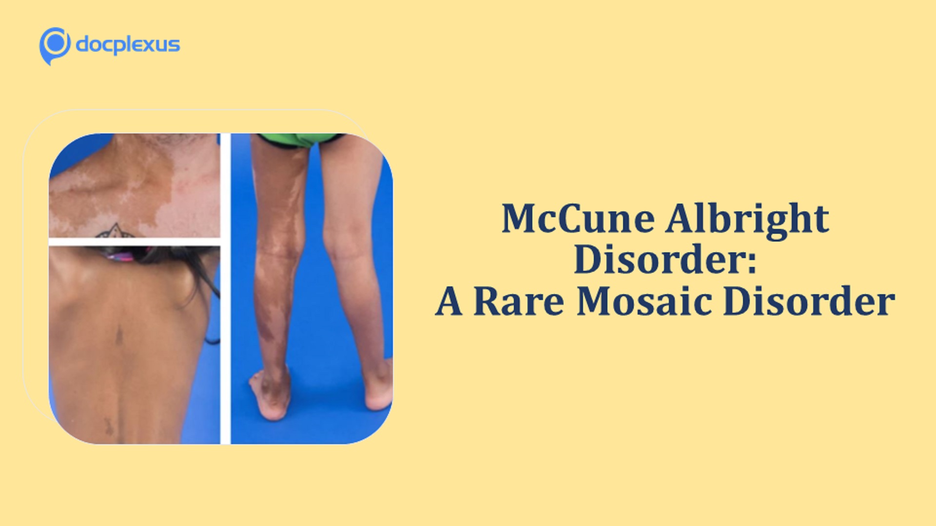 McCune Albright Disorder - A Rare Mosaic Disorder
