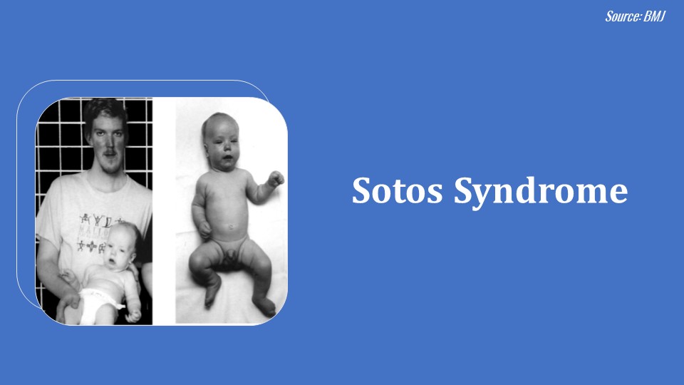 Answer This Question on Sotos Syndrome