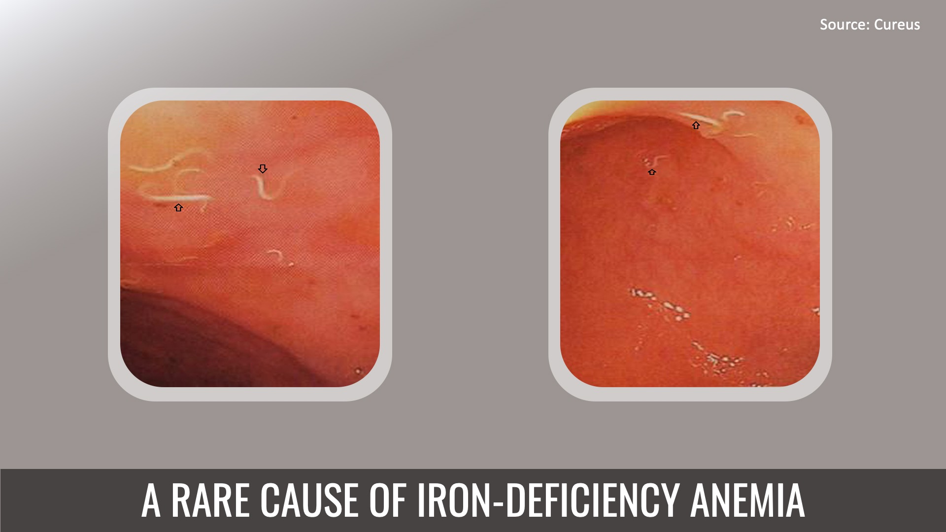Identify the Rare Cause of Iron-deficiency Anemia in This Geriatric Patient