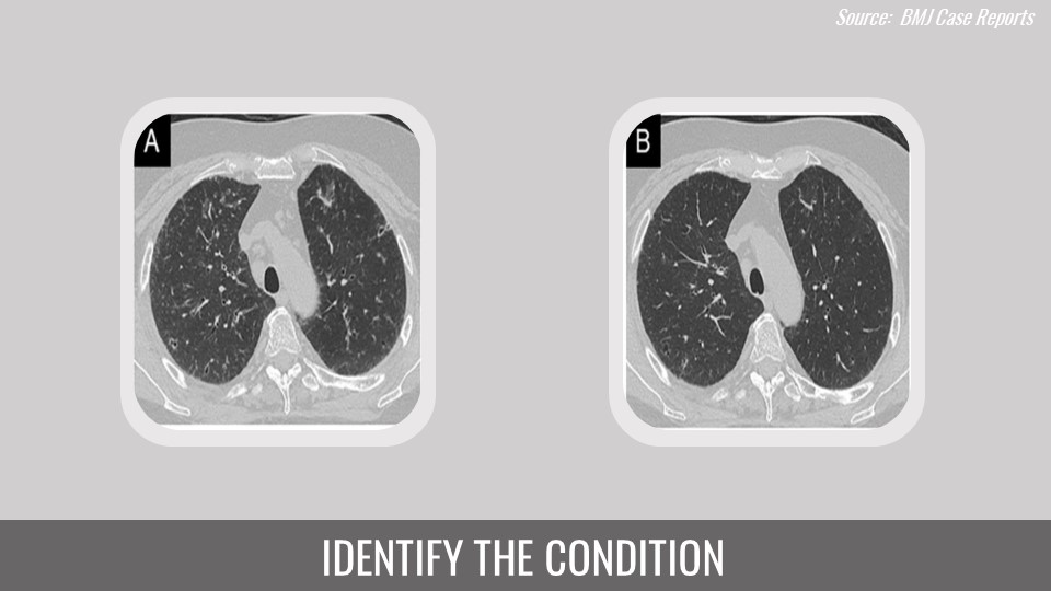 Case of a Woman with History of Bronchial Asthma