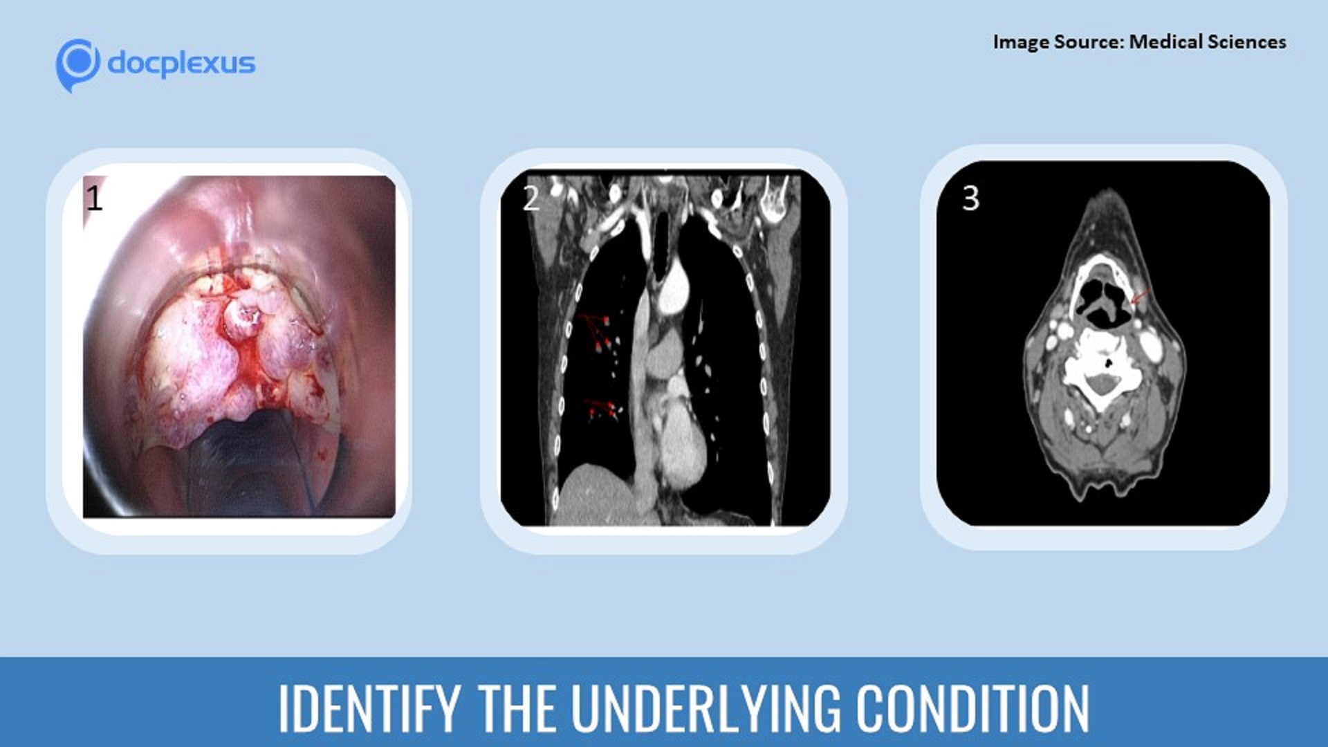 Solve This Case of Laryngeal Infection