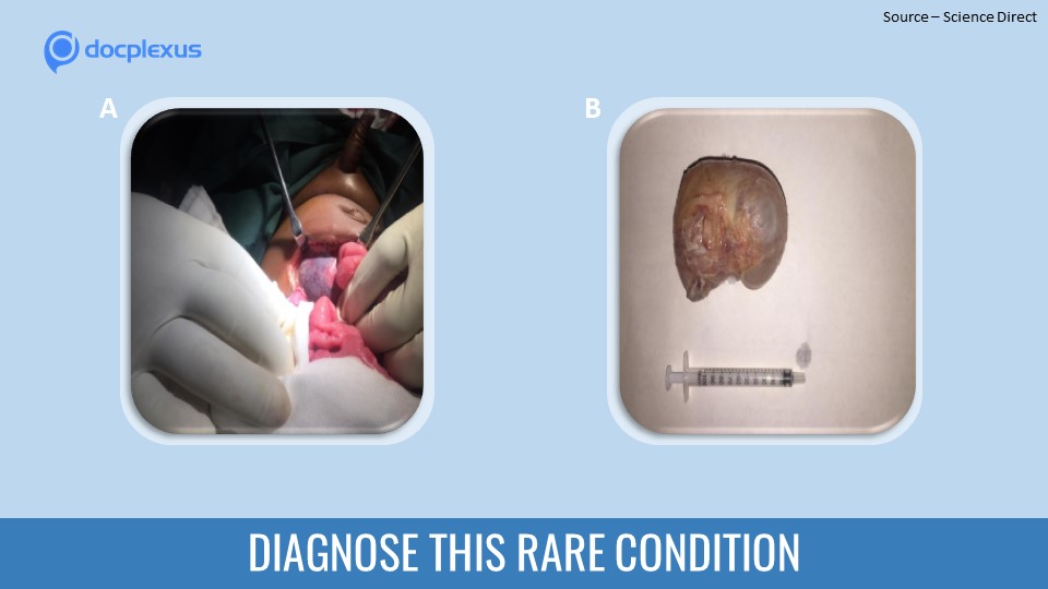 Identify the Rare Cause of Constipation in This Infant