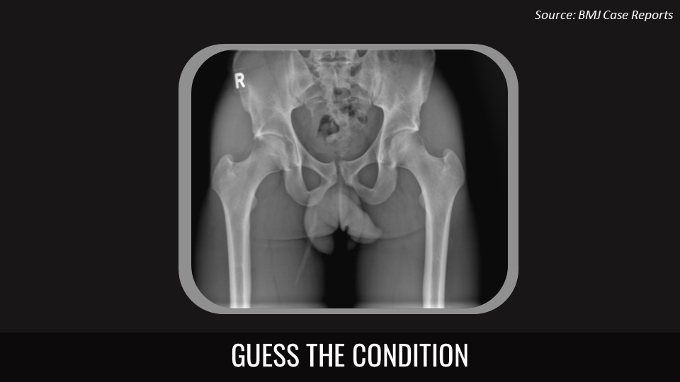 Case of a Football Player with Pain in the Right Groin
