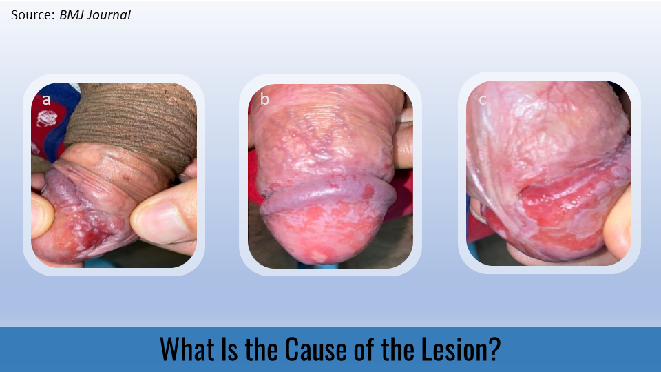 Penile Lesion with Truncal Maculopapular Rash – What's This Condition?