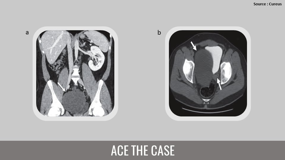 A Rare Etiology of Infertility – What’s Your Diagnosis?