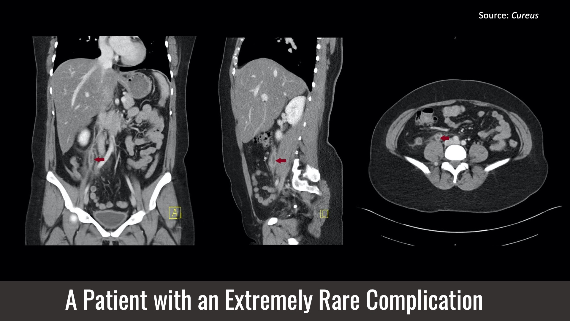 Identify the Cause of Abdominal Pain in This Patient