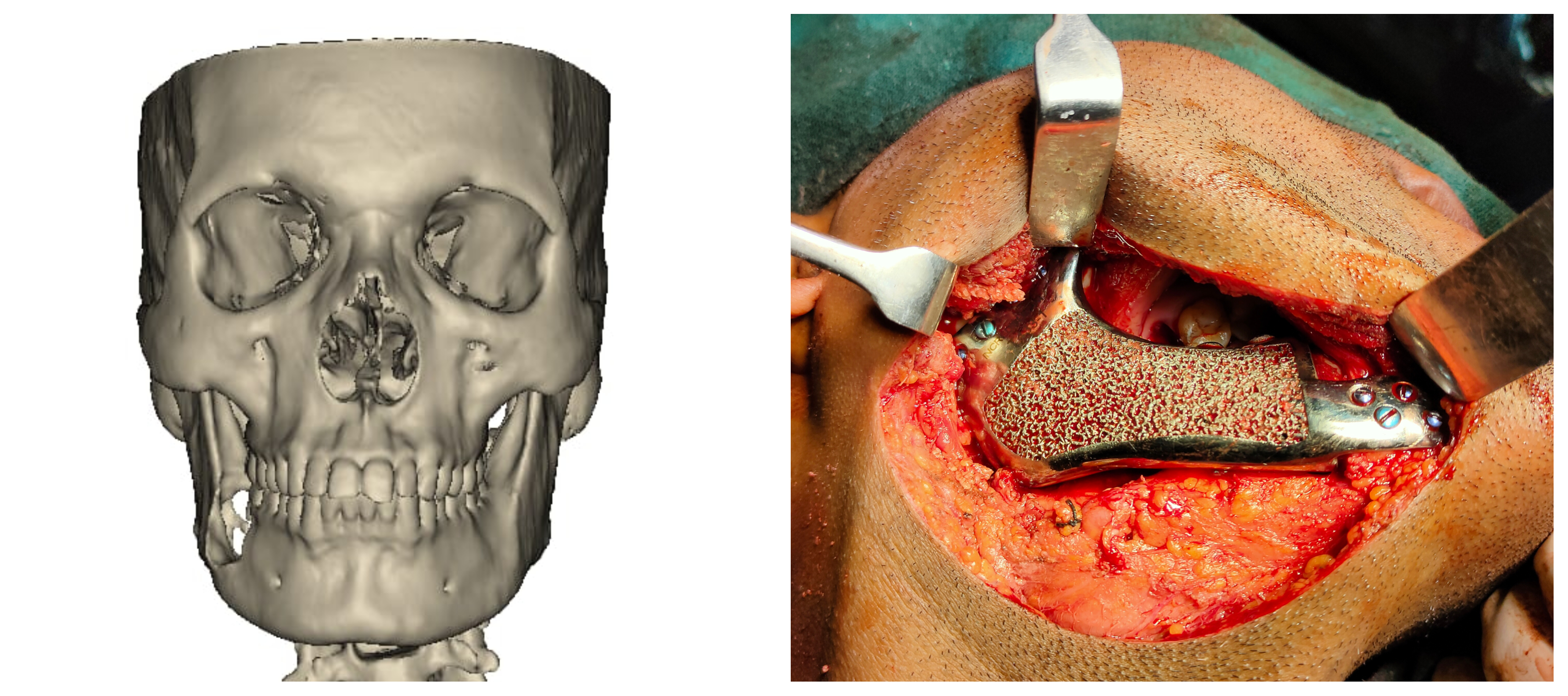 Use of 3D Printing in Complex Maxillofacial Defects