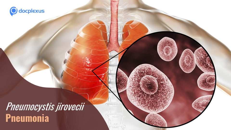 Recent Updates on Pneumocystis jirovecii Pneumonia