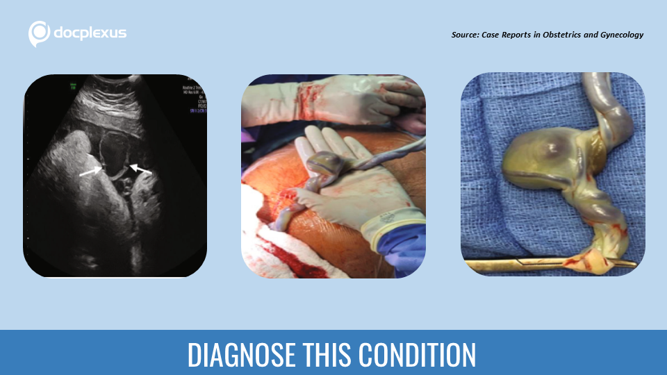 3rd Trimester Umbilical Anomaly & Stunted Fetal Growth  – Can you Diagnose the Condition?