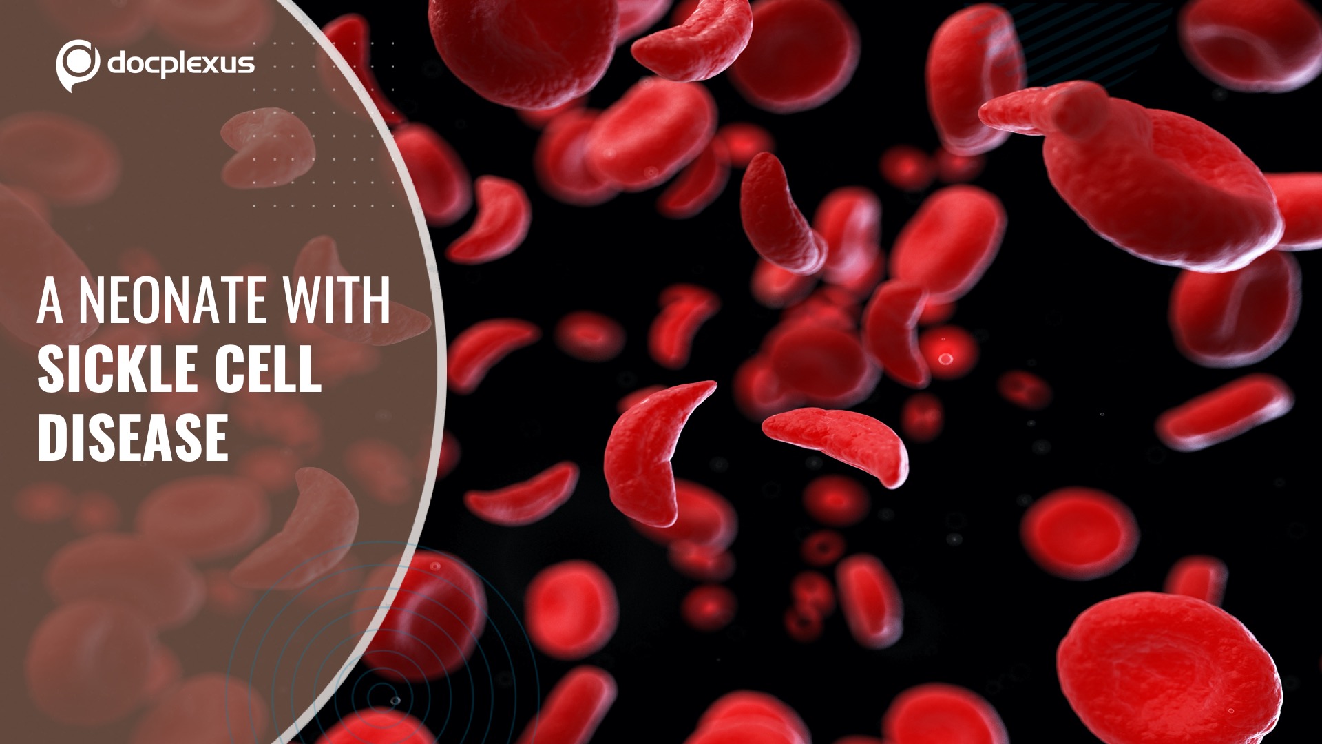 A Neonate with Sickle Cell Disease
