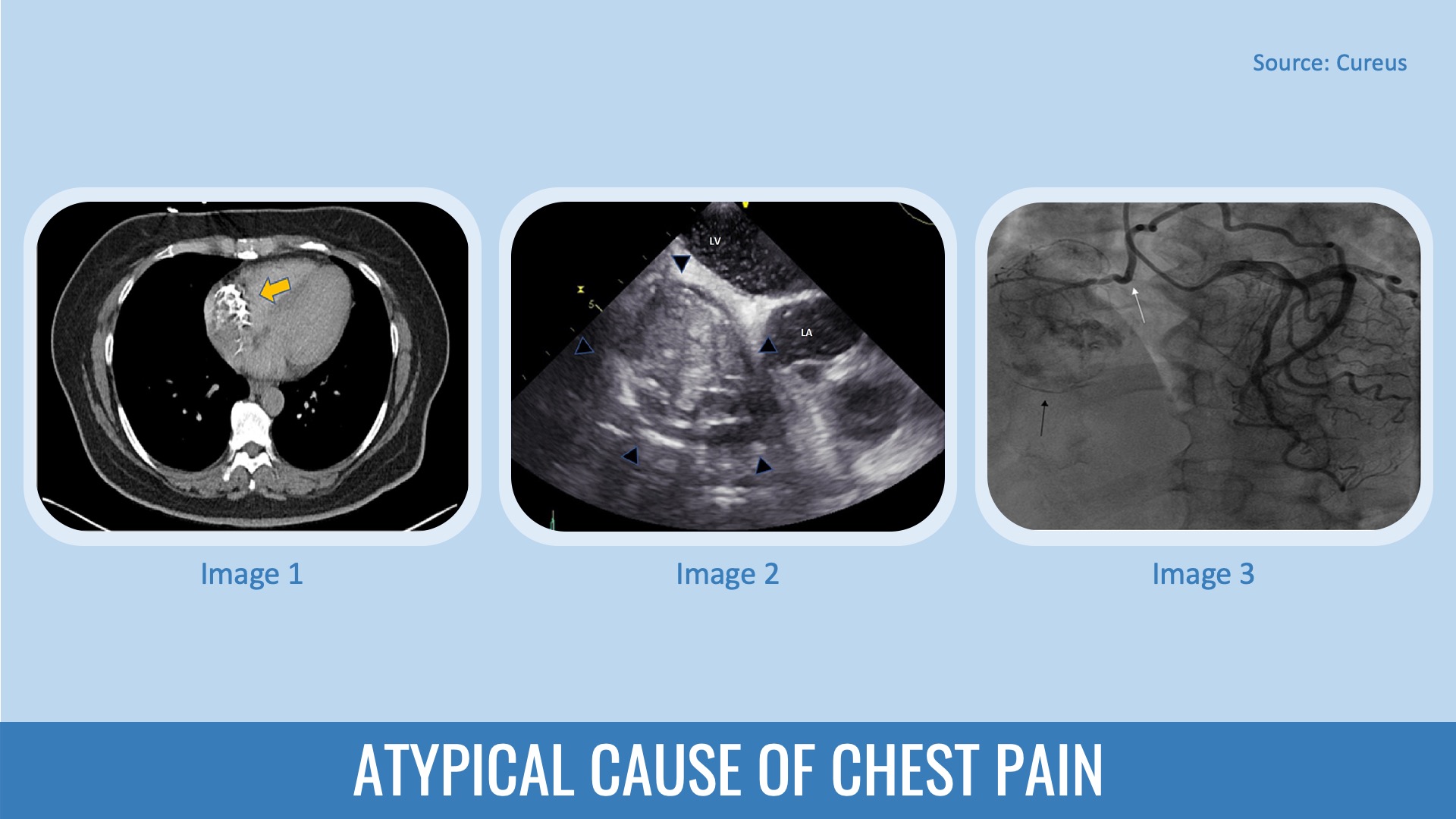 Identify the Cause of Chest Pain