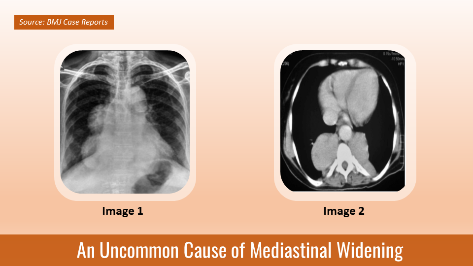 Identify the Cause of Mediastinal Widening in This Patient