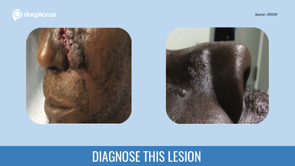 A Bleeding Fungating Facial Mass in an Elderly Man – What’s Your Diagnosis?