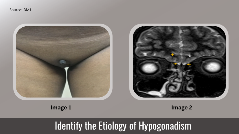 A Case of Congenital Hypogonadism and Anosmia