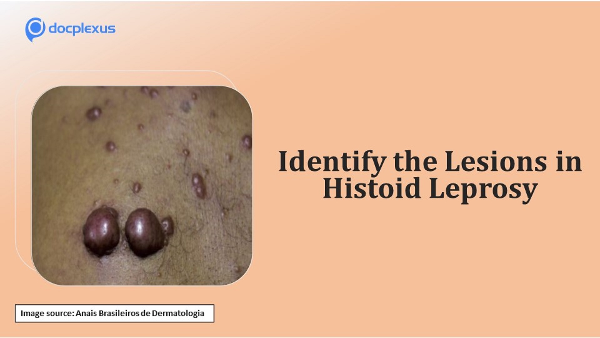 Identify These Lesions in Histoid Leprosy