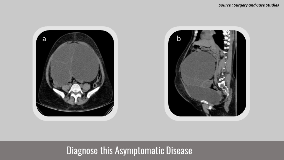 Identify the Reason of Abdominal Pain in a 48-year-old Woman