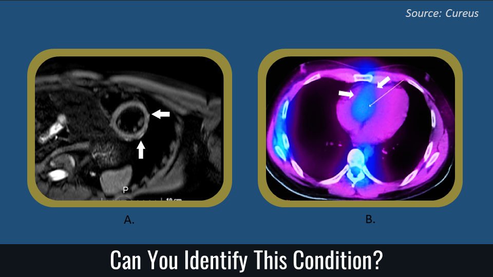 Severe Chest Pain Following COVID-19 - What is Your Diagnosis?