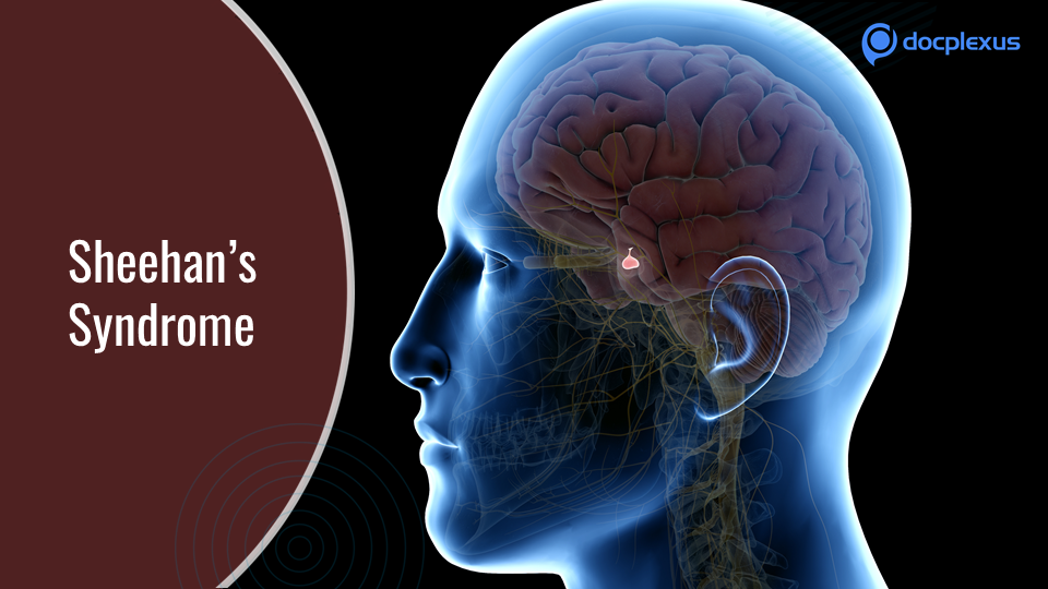 How Well Do You Know Sheehan’s Syndrome?