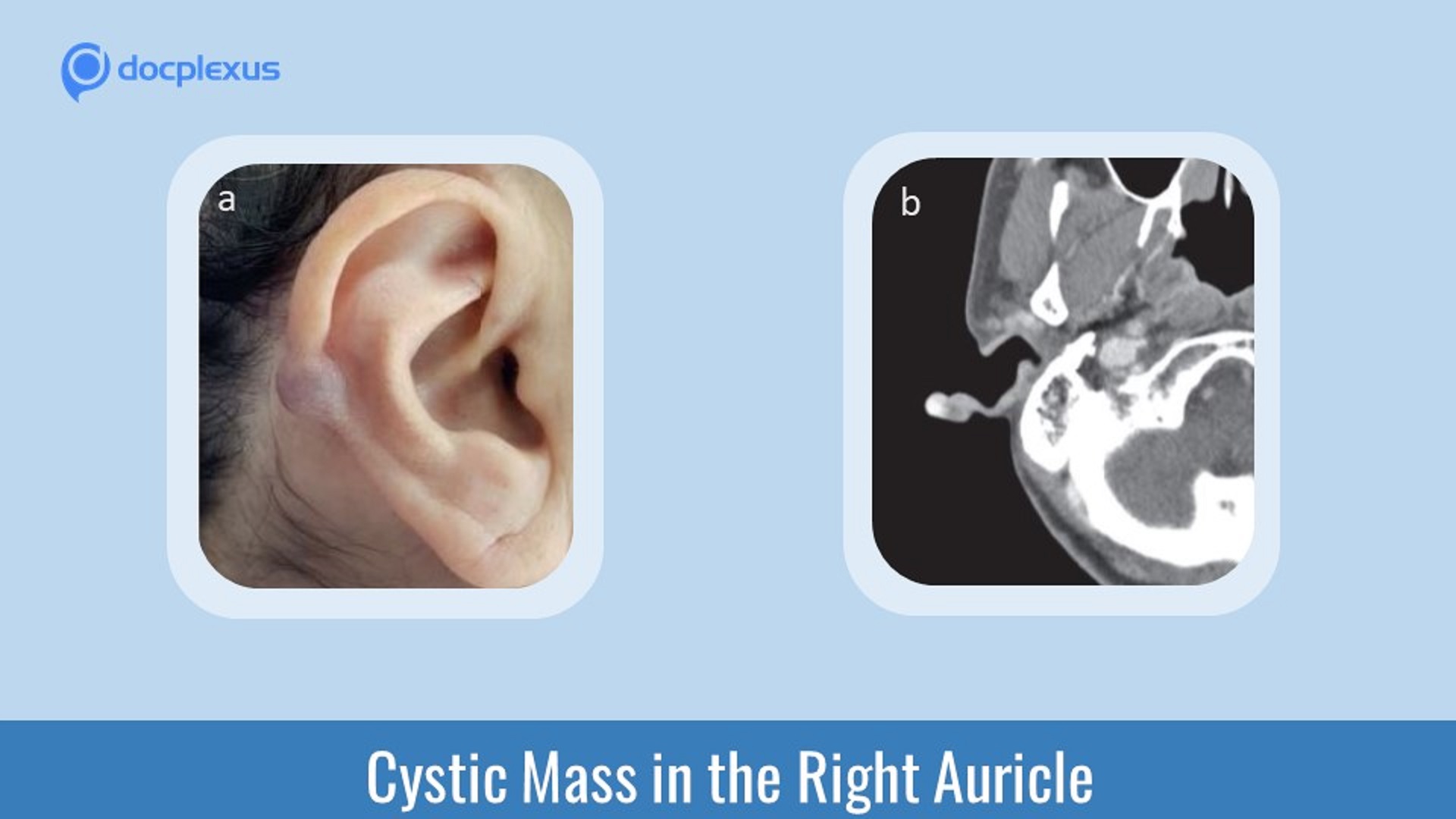 A Cystic Mass in the Right Auricle