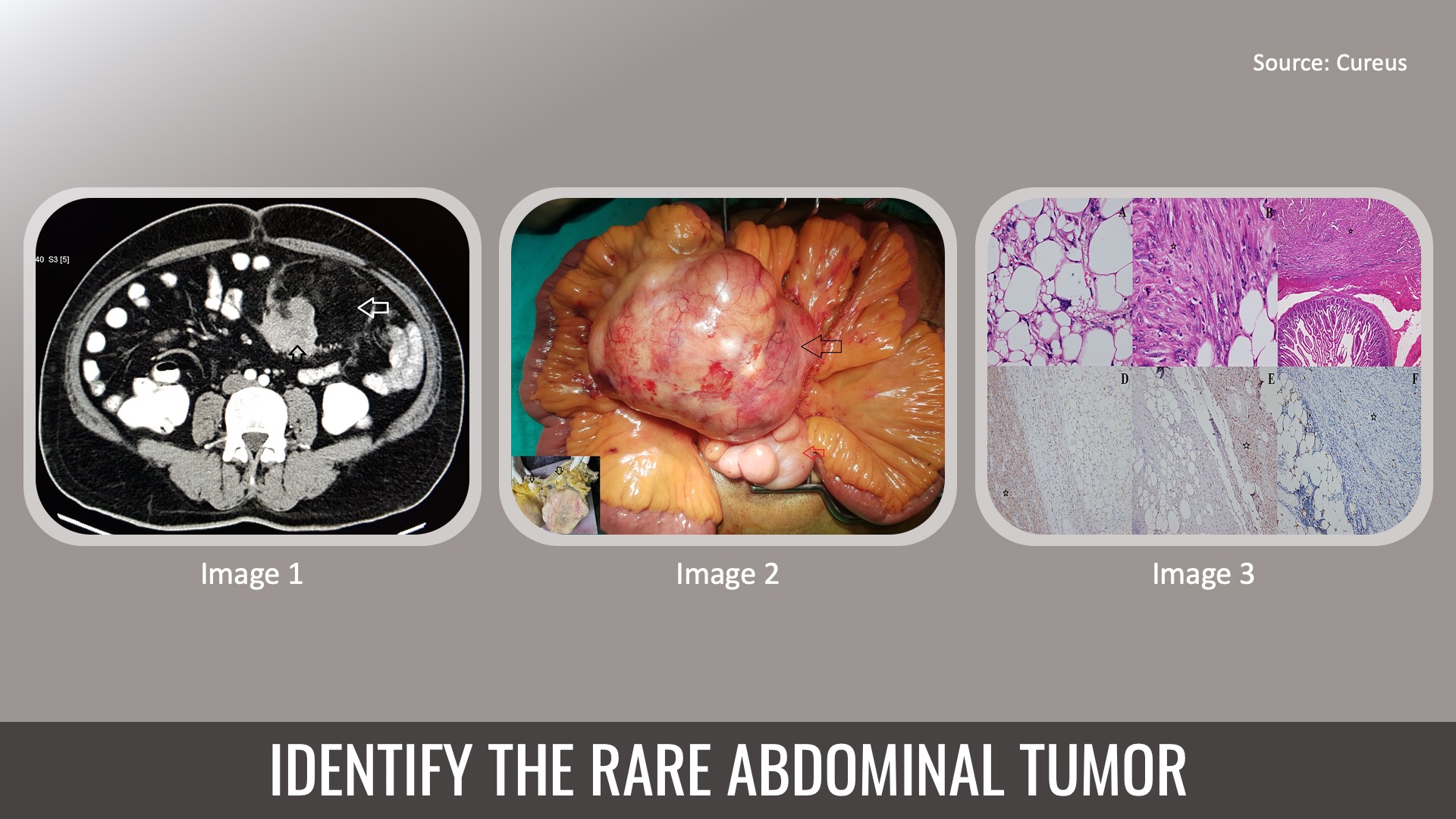 Abdominal Pain Caused by a Rare Tumor