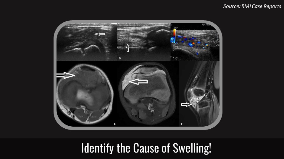 Case of a Child with Swelling on His Left Knee