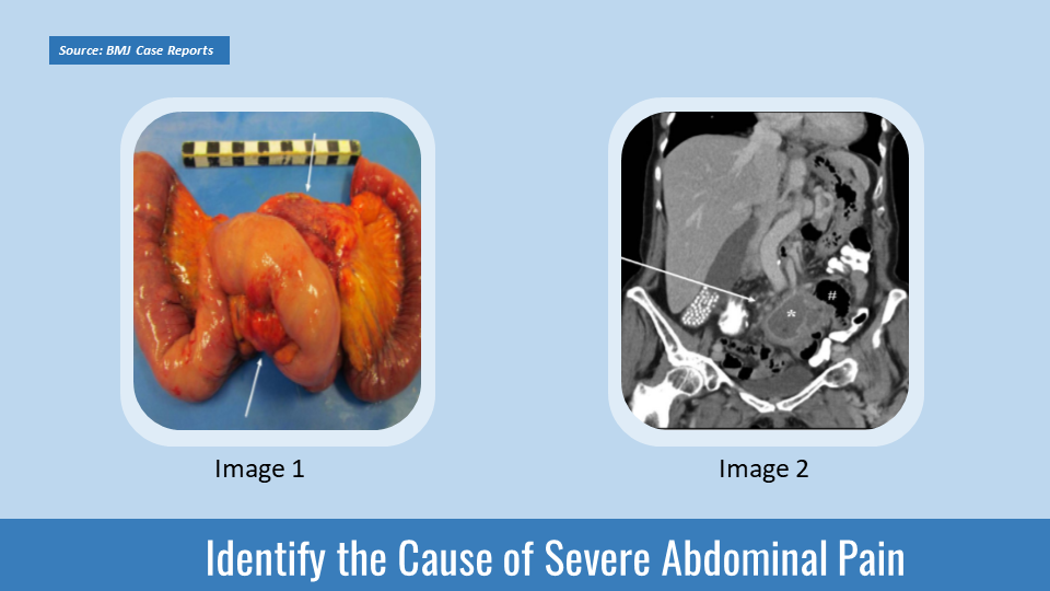 What Has Caused Severe Abdominal Pain in This 72-year-old Female?