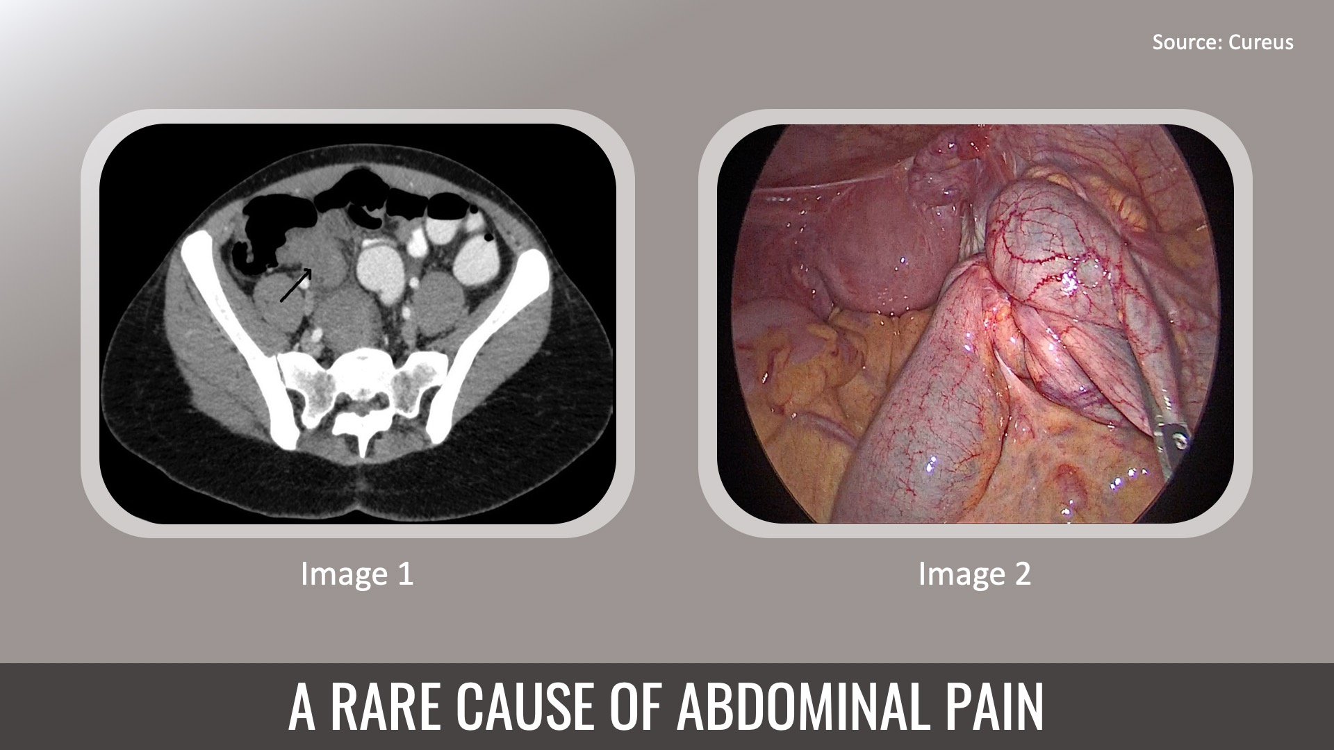 An Unusual Cause of Abdominal Pain