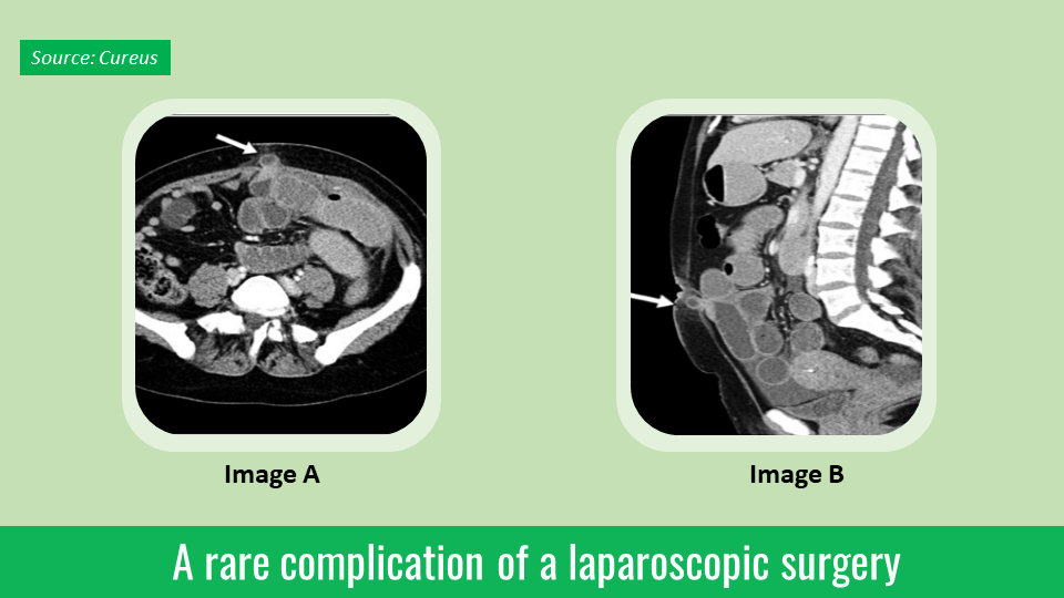 Identify the Cause of Abdominal Pain After Laparoscopic Cholecystectomy
