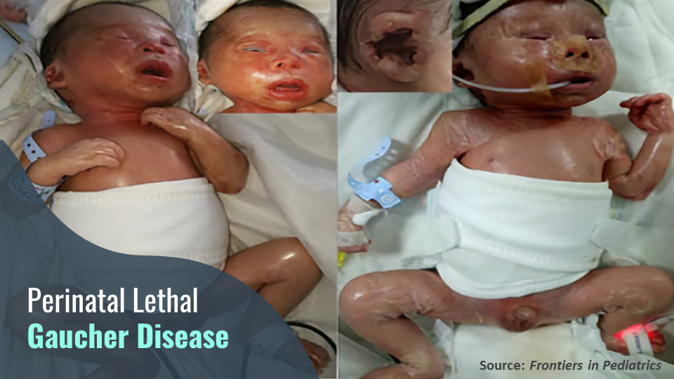 Perinatal Lethal Gaucher Disease – An Irreversible Loss!