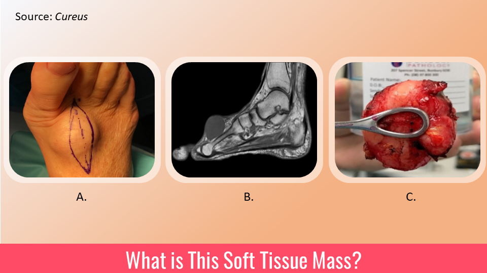 A Growing Mass on the Foot Dorsum – What is Your Diagnosis?