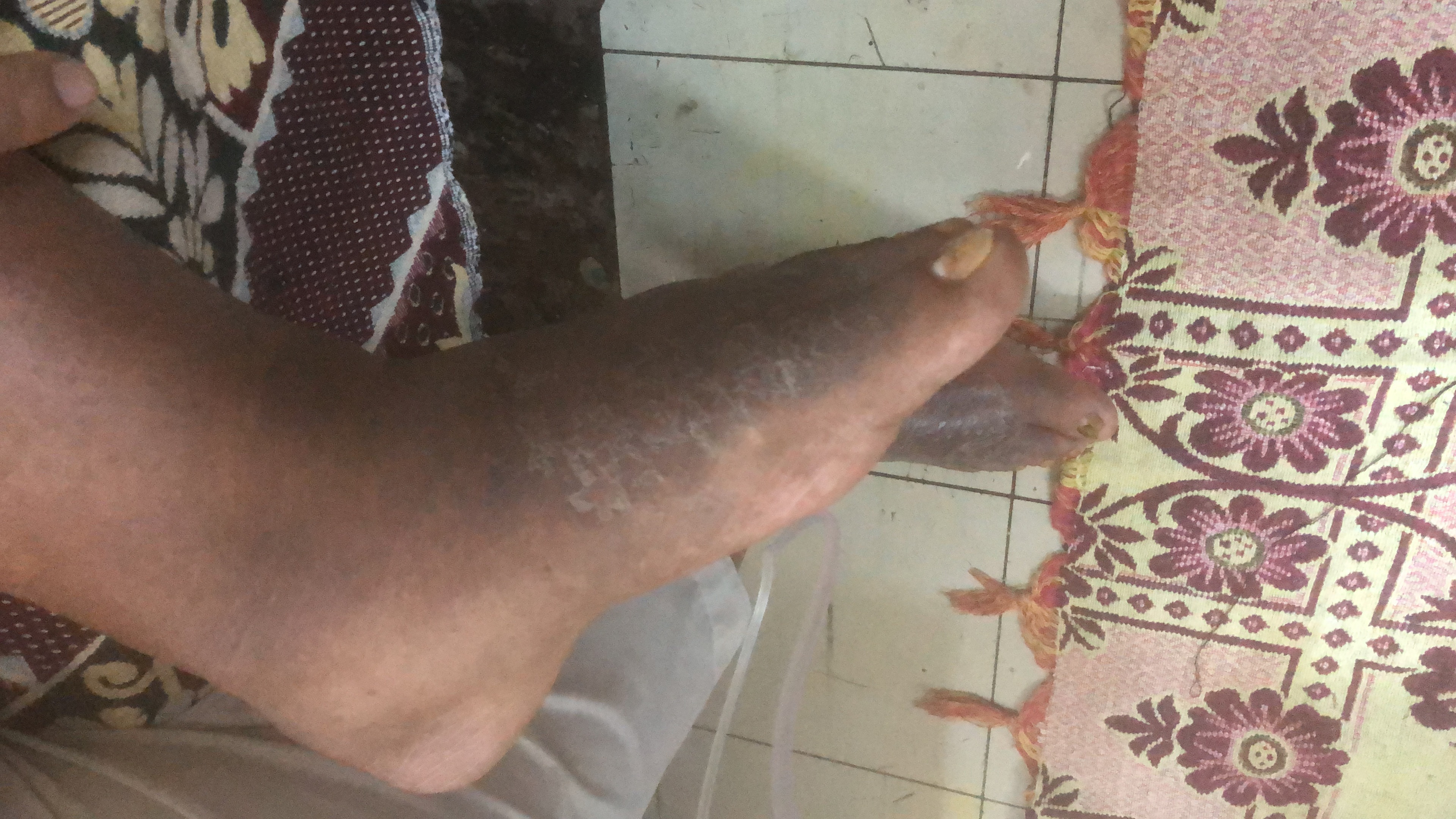Case of Old Male with Dryness in Both Foot