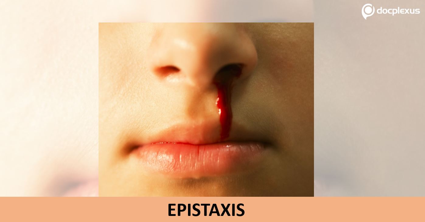 Which Statement on Epistaxis Is Incorrect?