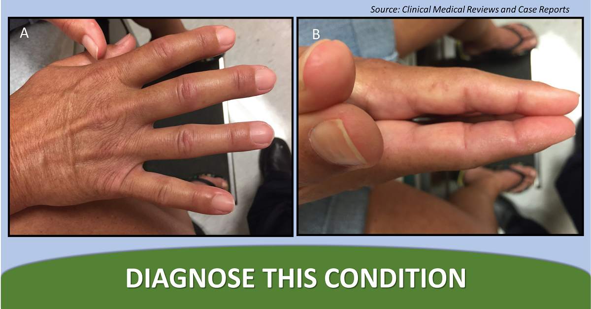 Diagnose This Diabetes-associated Complication