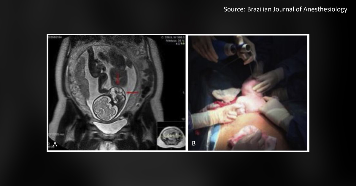 Which Anesthesia Would You Prefer for an EXIT Surgery of This Patient?