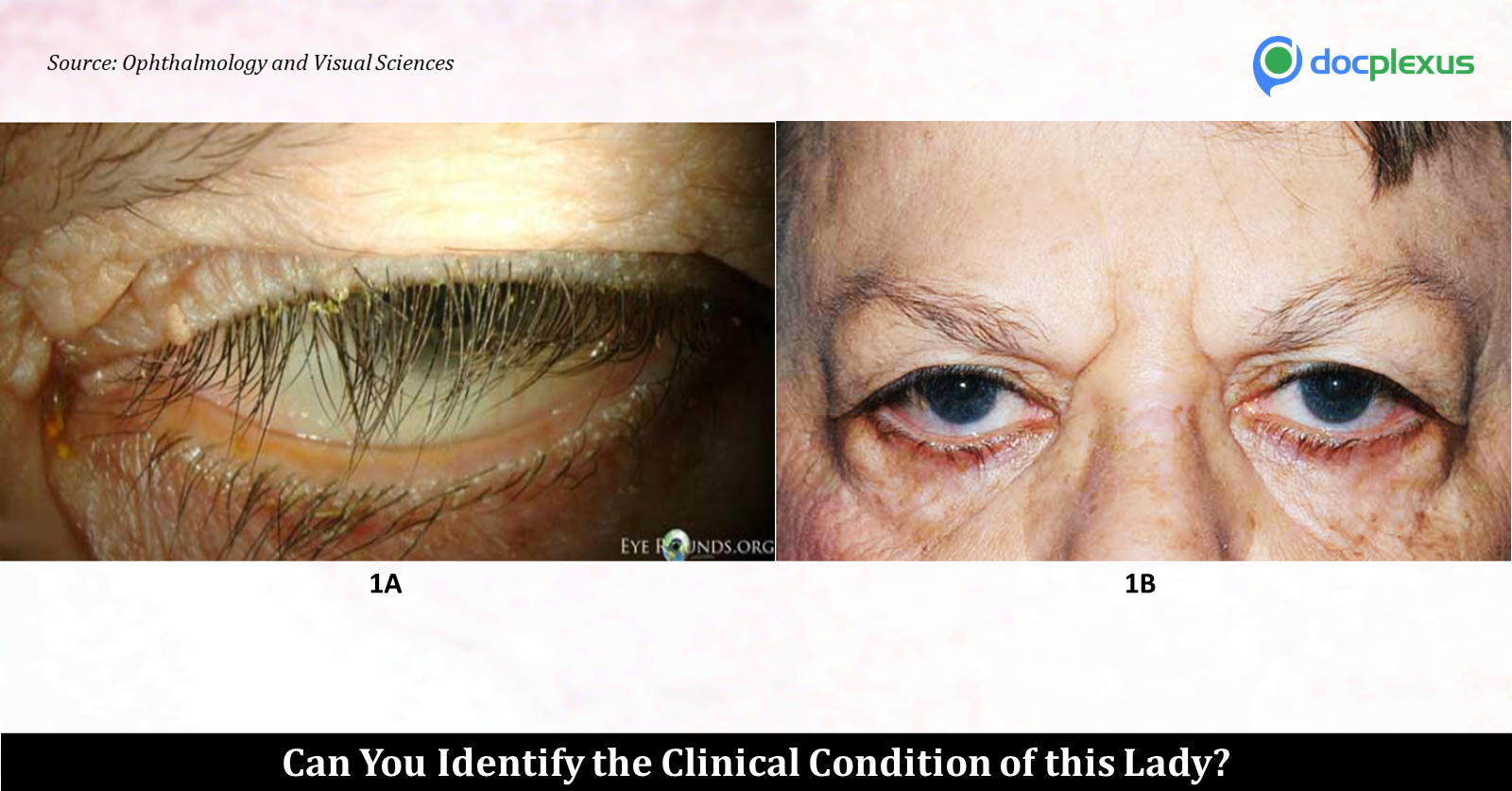 Identify the Cause Of Vision Loss With The Help Of Images!