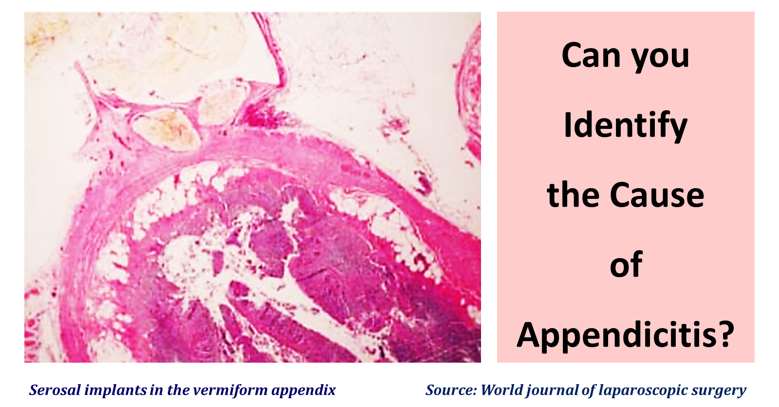 What Could be the Cause of Appendicitis in This Patient?