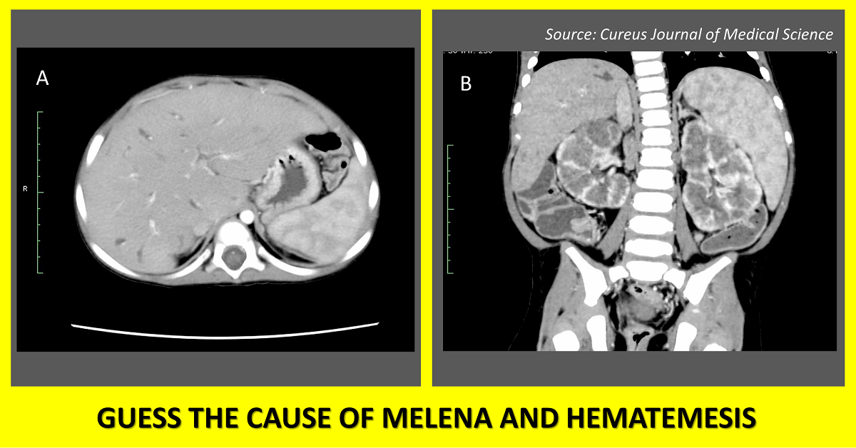 A Pediatric Case of Melena and Hematemesis