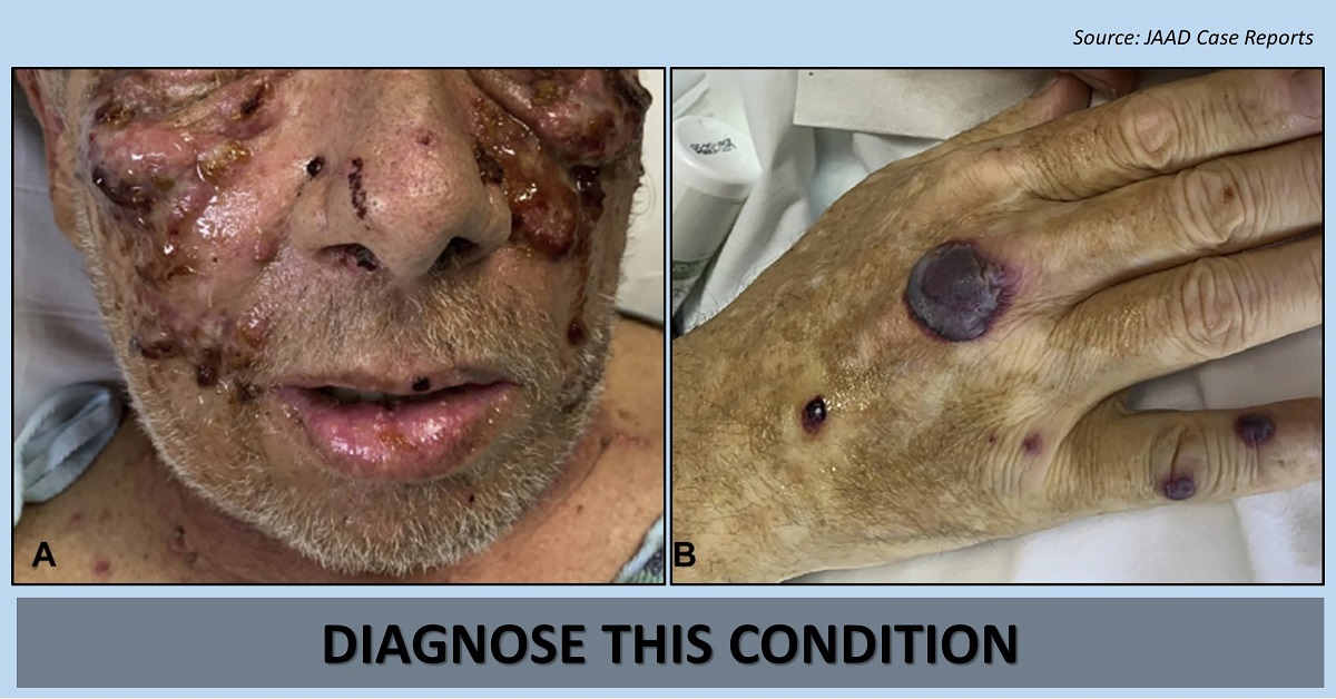 Diagnose This Dermatological Condition