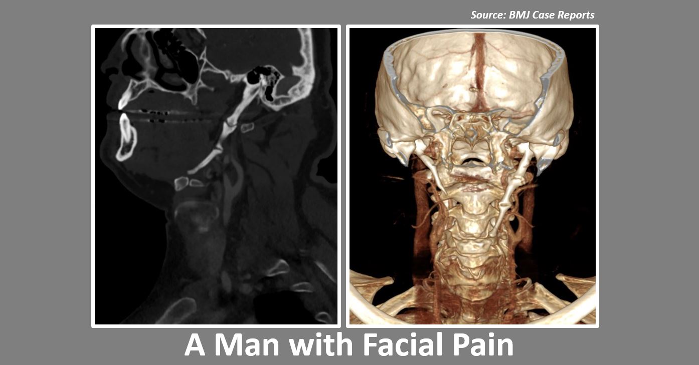 Facial Pain for Six Months: What’s Your Diagnosis?