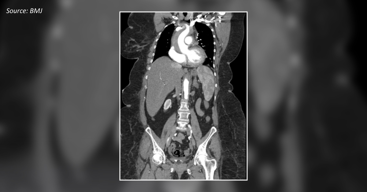 A Woman with Atypical Chest Pain