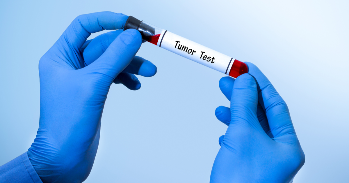 Fibulin-2, A Potential Biomarker for Grade II Meningioma